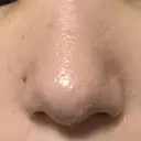 鼻尖形成（切開） / 小鼻縮小（切開） / その他（鼻） 東京形成美容外科 船橋院 AFTER サムネイル用