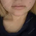 ボトックス（エラ・小顔） / ボトックス（口角） フォンタナクリニック天神 AFTER サムネイル用