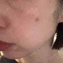 ボトックス（眉間） / 光治療（フォトフェイシャルなど） / ピコスポット Kaleido Clinic（カレイドクリニック） 横浜 DAY 5 サムネイル用