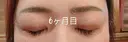 目元修正 / 自然癒着法 LUHO（ルホ）美容外科 AFTER サムネイル用