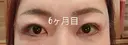 目元修正 / 自然癒着法 LUHO（ルホ）美容外科 DAY 188 サムネイル用