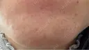 水光注射（ハリ・美肌） / 肌育注射（ジュベルックなど） スマートスキンクリニック 神保町院 DAY 0 サムネイル用