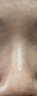 水光注射（ハリ・美肌） / 肌育注射（ジュベルックなど） スマートスキンクリニック 神保町院 DAY 0 サムネイル用