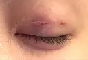 二重埋没 フローラクリニック DAY 15 サムネイル用