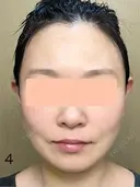 糸リフト / 脂肪吸引（顔） 脂肪吸引ラボトウキョウ DAY 4 サムネイル用