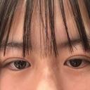 二重埋没 湘南美容クリニック 千葉センシティ院 DAY 2 サムネイル用