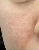水光注射（ハリ・美肌） / 肌育注射（ジュベルックなど） スマートスキンクリニック 神保町院 DAY 1 サムネイル用