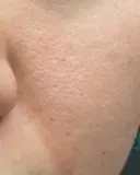 水光注射（ハリ・美肌） / 肌育注射（ジュベルックなど） スマートスキンクリニック 神保町院 DAY 1 サムネイル用