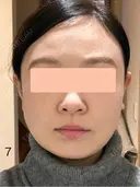 糸リフト / 脂肪吸引（顔） 脂肪吸引ラボトウキョウ DAY 7 サムネイル用