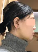 糸リフト / 脂肪吸引（顔） 脂肪吸引ラボトウキョウ DAY 7 サムネイル用