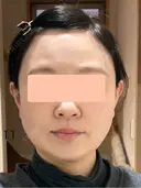 糸リフト / 脂肪吸引（顔） 脂肪吸引ラボトウキョウ DAY 11 サムネイル用
