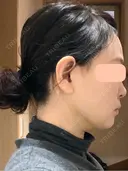 糸リフト / 脂肪吸引（顔） 脂肪吸引ラボトウキョウ DAY 11 サムネイル用