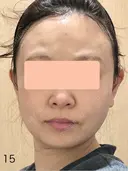 糸リフト / 脂肪吸引（顔） 脂肪吸引ラボトウキョウ DAY 15 サムネイル用
