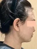 糸リフト / 脂肪吸引（顔） 脂肪吸引ラボトウキョウ DAY 15 サムネイル用
