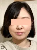 糸リフト / 脂肪吸引（顔） 脂肪吸引ラボトウキョウ AFTER サムネイル用