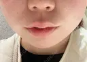 ボトックス（エラ・小顔） BiBiクリニック DAY 0 サムネイル用
