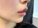 ヒアルロン酸注入（涙袋） / ヒアルロン酸注入（唇） / ボトックス（口角） ルラ美容クリニック 渋谷本院 DAY 0 サムネイル用