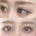 目尻切開 / 目尻靭帯移動 FROM B整形外科 (旧バウム整形外科) DAY 25 サムネイル用