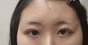 二重埋没 HAAB×DREAM BEAUTY CLINIC 大阪梅田院 DAY 6 サムネイル用
