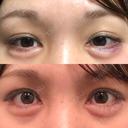 ヒアルロン酸注入（涙袋） 共立美容外科 京都院 AFTER サムネイル用