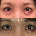 ヒアルロン酸注入（涙袋） 共立美容外科 京都院 DAY 1 サムネイル用