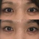 ヒアルロン酸注入（涙袋） 共立美容外科 京都院 DAY 1 サムネイル用
