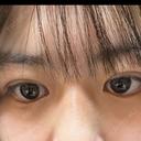 二重埋没 湘南美容クリニック 千葉センシティ院 DAY 3 サムネイル用
