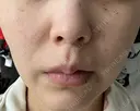 ヒアルロン酸注入（唇） / ボトックス（口角） / スネコス / ポテンツァ ルラ美容クリニック 札幌本院 DAY 3 サムネイル用