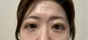 二重埋没 湘南美容クリニック 千葉センシティ院 DAY 5 サムネイル用