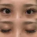 二重切開 / 目頭切開 オーキッド美容クリニック東京御徒町 AFTER サムネイル用