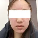 ルビーレーザー 日本美容・医療クリニック 六本木院 DAY 0 サムネイル用