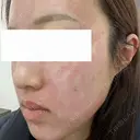 ルビーレーザー 日本美容・医療クリニック 六本木院 DAY 0 サムネイル用