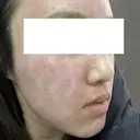 ルビーレーザー 日本美容・医療クリニック 六本木院 DAY 0 サムネイル用