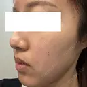 ルビーレーザー 日本美容・医療クリニック 六本木院 DAY 1 サムネイル用