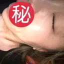ヒアルロン酸注入（鼻） / ヒアルロン酸注入（唇） / ボトックス（目尻） HAAB×DREAM BEAUTY CLINIC 大阪梅田院 AFTER サムネイル用