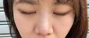二重埋没 / 隆鼻術 / 鼻尖形成（切開） / 小鼻縮小（切開） / 軟骨移植 R Beauty CLINIC 名古屋院 DAY 154 サムネイル用