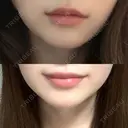 ヒアルロン酸注入（涙袋） / ヒアルロン酸注入（唇） ブルームクリニック（BLOOM CLINIC） AFTER サムネイル用