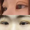 二重埋没 / 上まぶたの脂肪取り / 脂肪溶解注射（顔） TCB東京中央美容外科 前橋院 DAY 5 サムネイル用