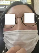 スネコス ミニマムスキンクリニック池袋 DAY 0 サムネイル用