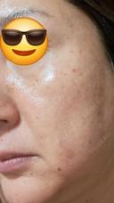 水光注射（ハリ・美肌） しんゆり美容健康クリニック DAY 1 サムネイル用
