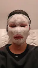 ダーマペン DAILY SKIN CLINIC 心斎橋院 AFTER サムネイル用