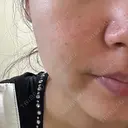 ボトックス（あご） / ボトックス（エラ・小顔） Zetith Beauty Clinic 福岡院 AFTER サムネイル用