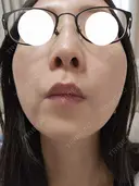 スネコス ミニマムスキンクリニック池袋 DAY 1 サムネイル用