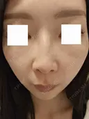 スネコス ミニマムスキンクリニック池袋 DAY 1 サムネイル用