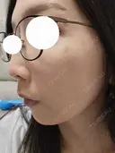 スネコス ミニマムスキンクリニック池袋 DAY 1 サムネイル用