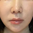人中短縮 聖心美容クリニック 六本木院 AFTER サムネイル用