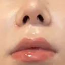 人中短縮 聖心美容クリニック 六本木院 DAY 92 サムネイル用