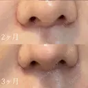 人中短縮 聖心美容クリニック 六本木院 DAY 92 サムネイル用