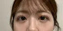 二重埋没 湘南美容クリニック 千葉センシティ院 DAY 6 サムネイル用
