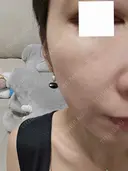 スネコス ミニマムスキンクリニック池袋 DAY 2 サムネイル用